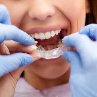 Invisalign Invisalign